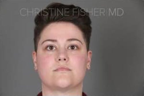 After procedure image for Botox® & Dysport®