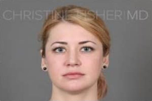 After procedure image for Botox® & Dysport®