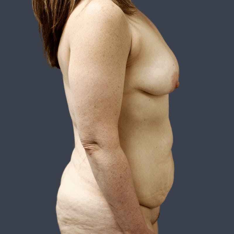 Mommy Makeover Before & After Gallery - Patient 260720 - Image 5