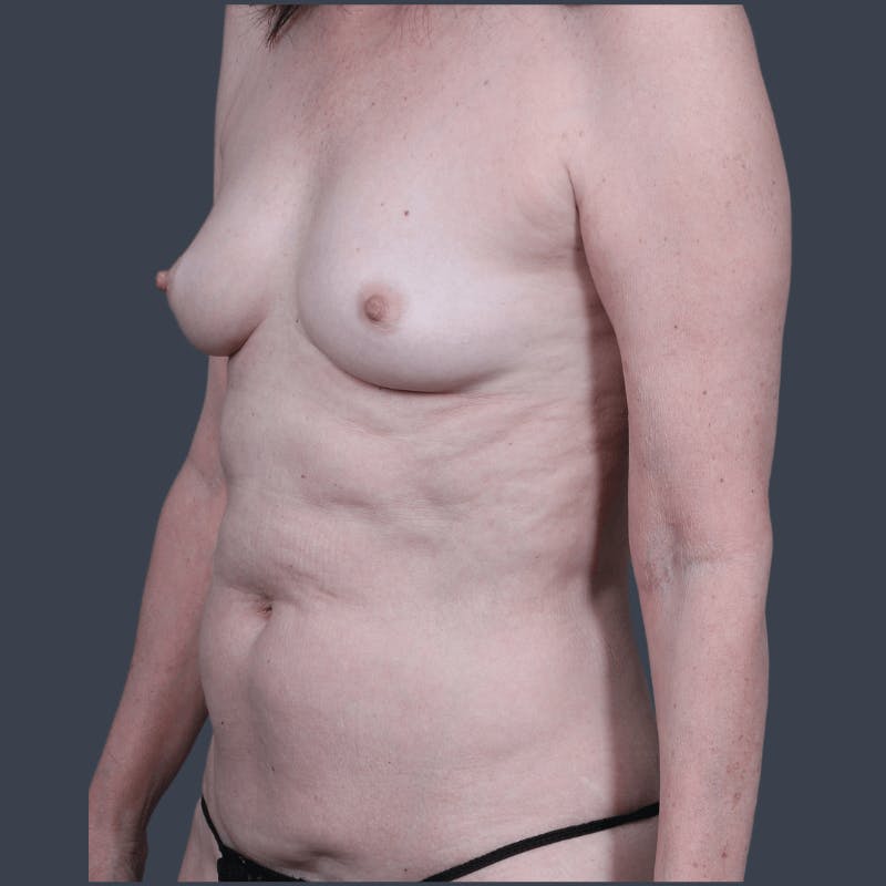 Breast Augmentation Before & After Gallery - Patient 104361 - Image 5