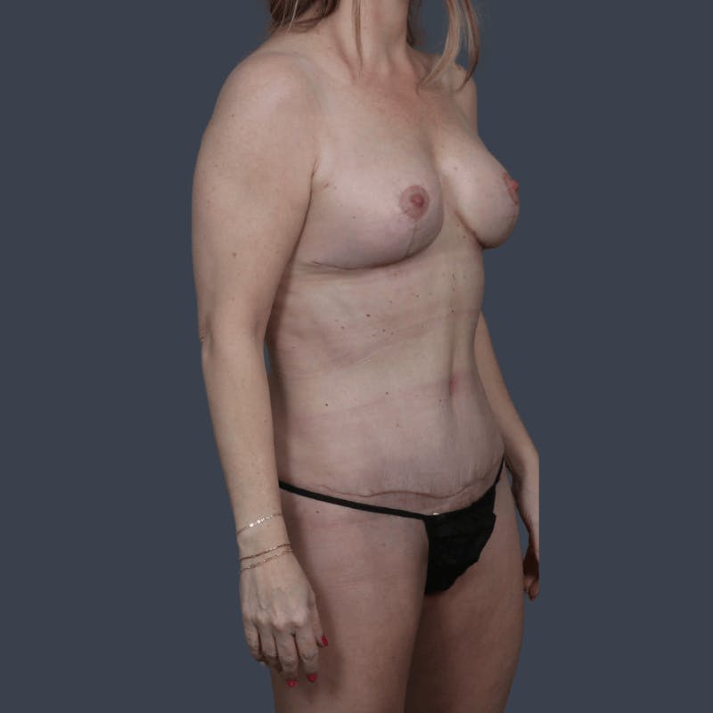 Mommy Makeover Before & After Gallery - Patient 401547 - Image 4