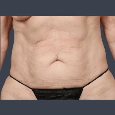 Abdominoplasty / Tummy Tuck Before & After Gallery - Patient 146420 - Image 1
