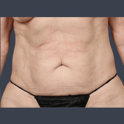 Abdominoplasty / Tummy Tuck Before & After Gallery - Patient 391844 - Image 1