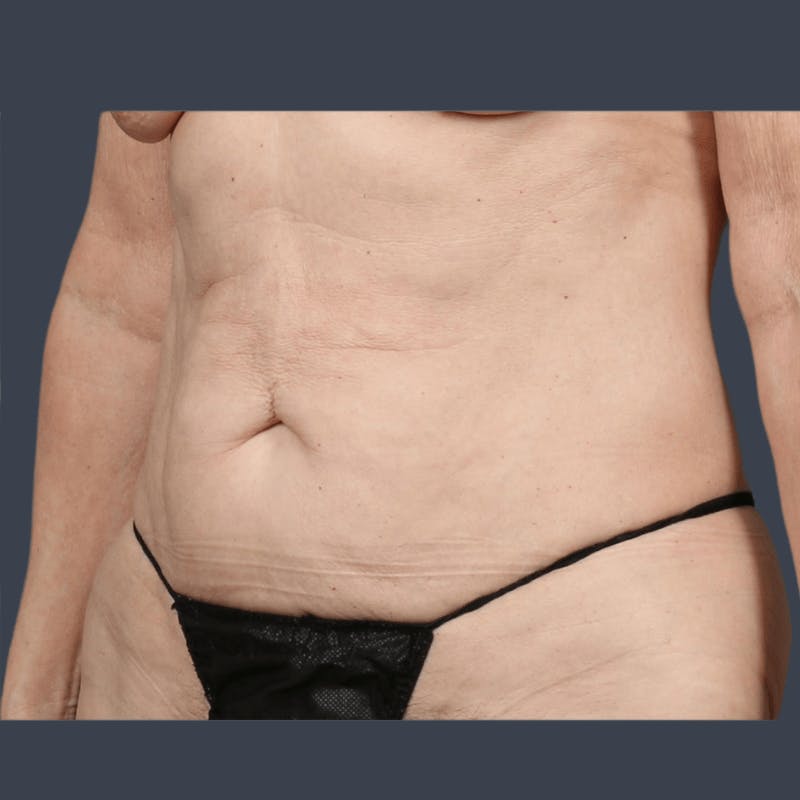 Abdominoplasty / Tummy Tuck Before & After Gallery - Patient 241742 - Image 5