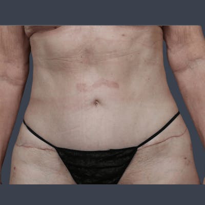 Abdominoplasty / Tummy Tuck Before & After Gallery - Patient 146420 - Image 2