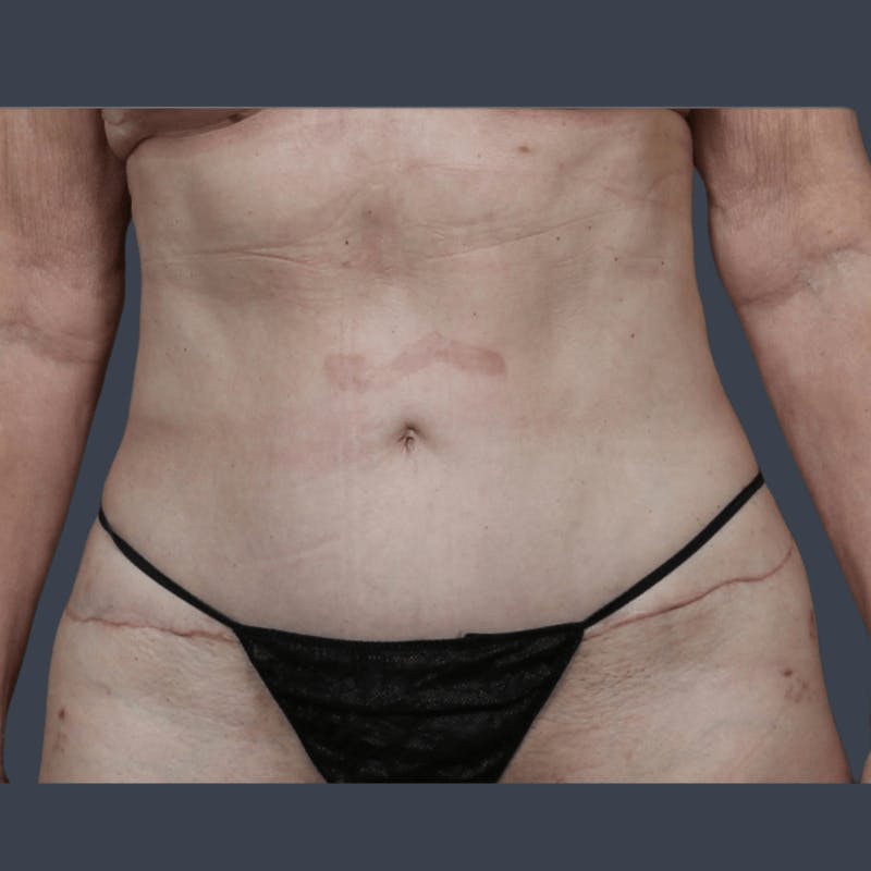 Abdominoplasty / Tummy Tuck Before & After Gallery - Patient 241742 - Image 2