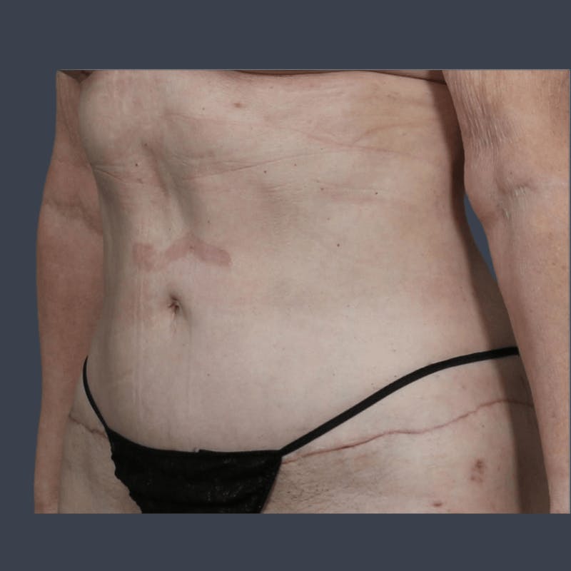 Abdominoplasty / Tummy Tuck Before & After Gallery - Patient 241742 - Image 6
