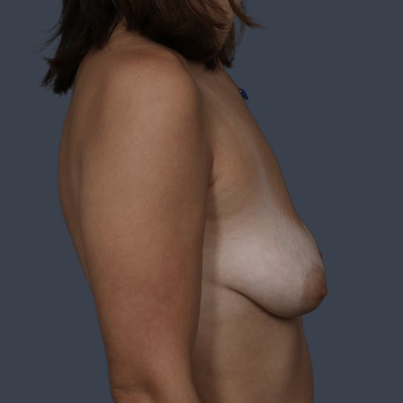 Implant Breast Reconstruction Before & After Gallery - Patient 147946 - Image 5