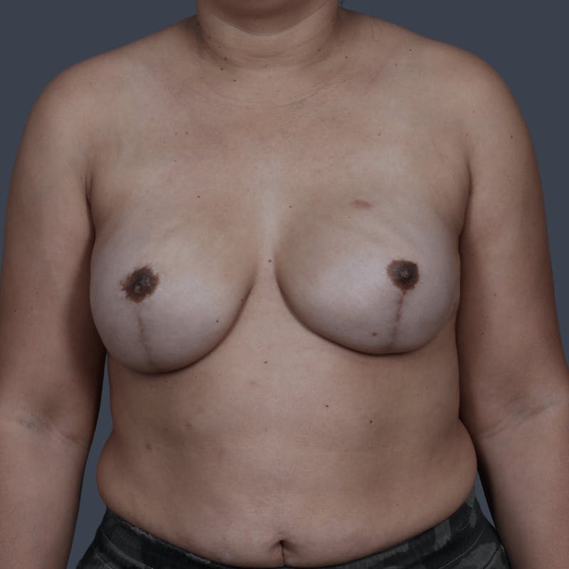 Implant Breast Reconstruction Before & After Gallery - Patient 107344 - Image 2