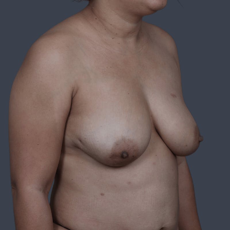 Implant Breast Reconstruction Before & After Gallery - Patient 107344 - Image 5