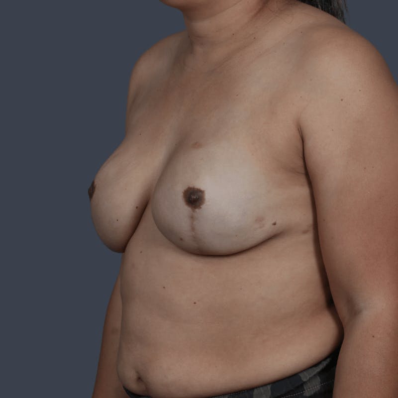 Implant Breast Reconstruction Before & After Gallery - Patient 107344 - Image 8