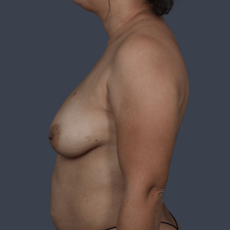 Implant Breast Reconstruction Before & After Gallery - Patient 107344 - Image 9