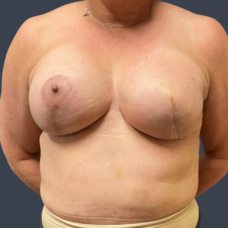 Implant Breast Reconstruction Before & After Gallery - Patient 414346 - Image 2