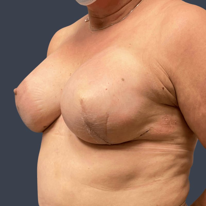 Implant Breast Reconstruction Before & After Gallery - Patient 414346 - Image 4