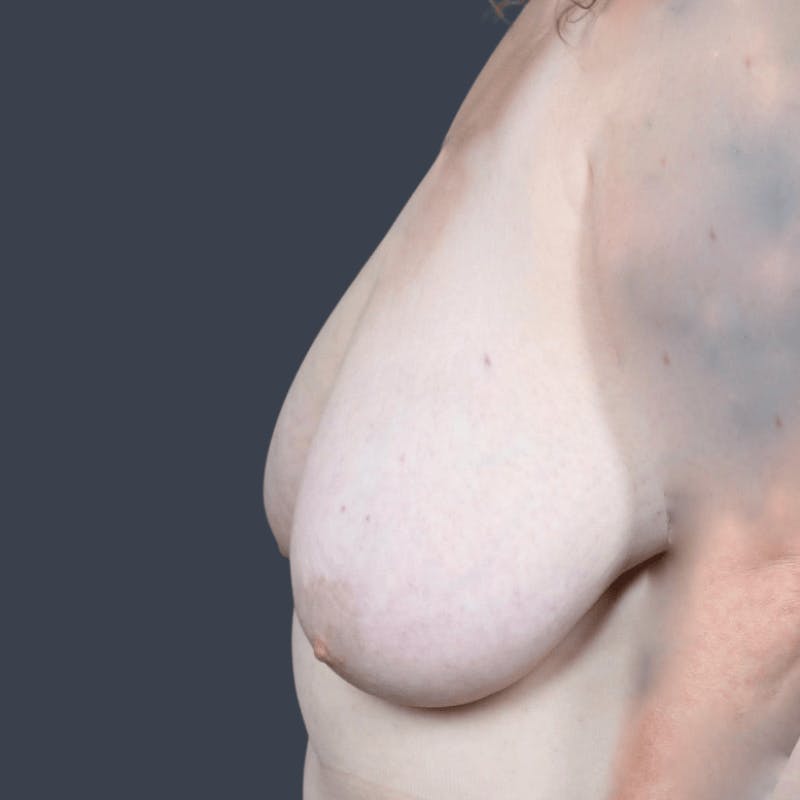 Implant Breast Reconstruction Before & After Gallery - Patient 119867 - Image 5