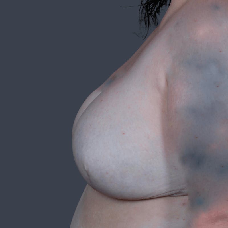 Implant Breast Reconstruction Before & After Gallery - Patient 119867 - Image 6