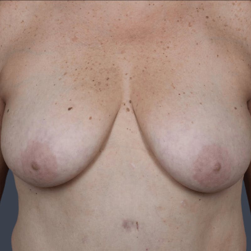 Implant Breast Reconstruction Before & After Gallery - Patient 422290 - Image 1