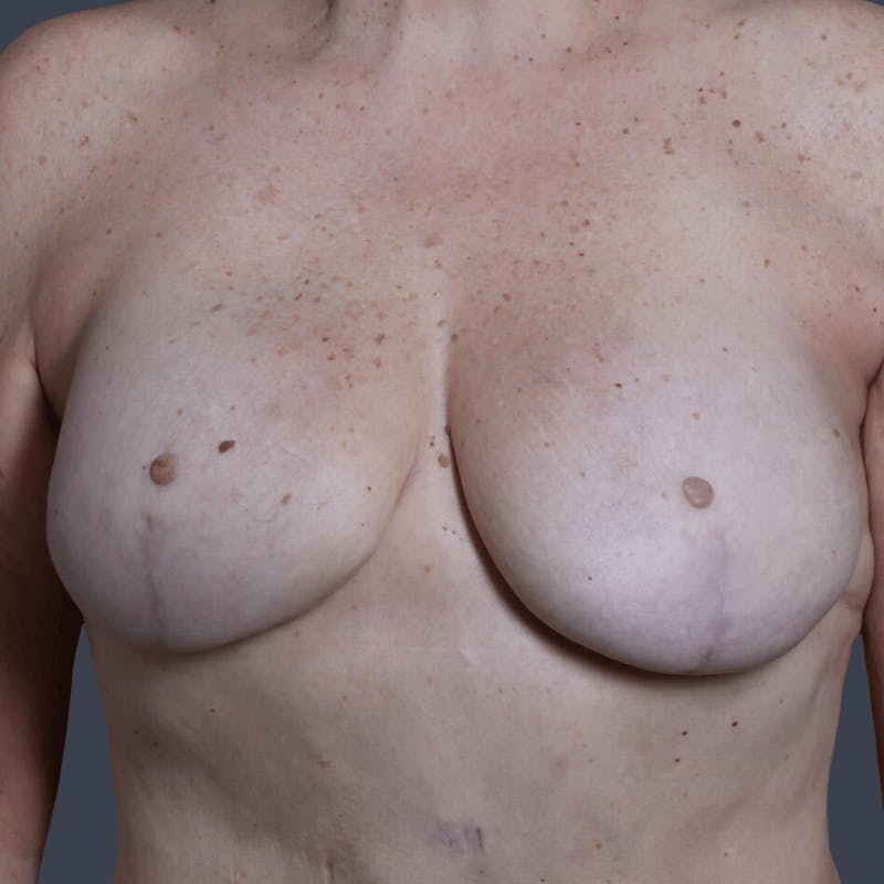 Implant Breast Reconstruction Before & After Gallery - Patient 422290 - Image 2