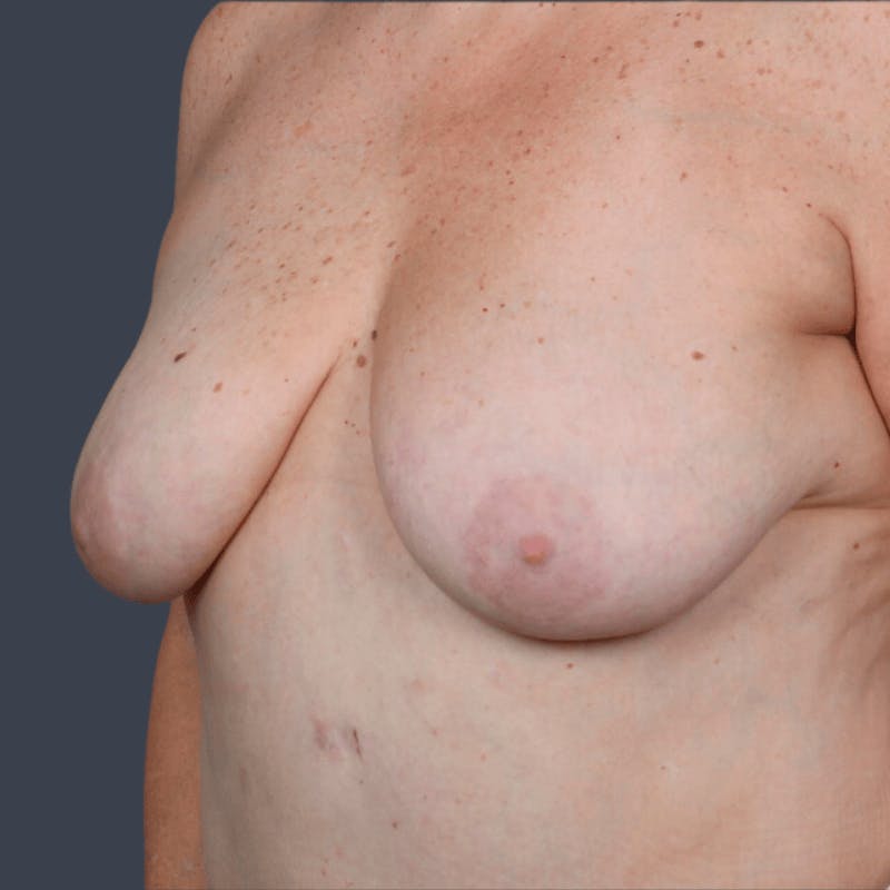 Implant Breast Reconstruction Before & After Gallery - Patient 422290 - Image 3