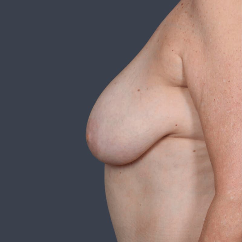 Implant Breast Reconstruction Before & After Gallery - Patient 422290 - Image 5