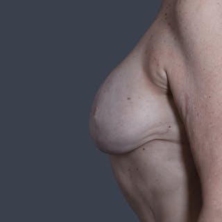 Implant Breast Reconstruction Before & After Gallery - Patient 422290 - Image 6