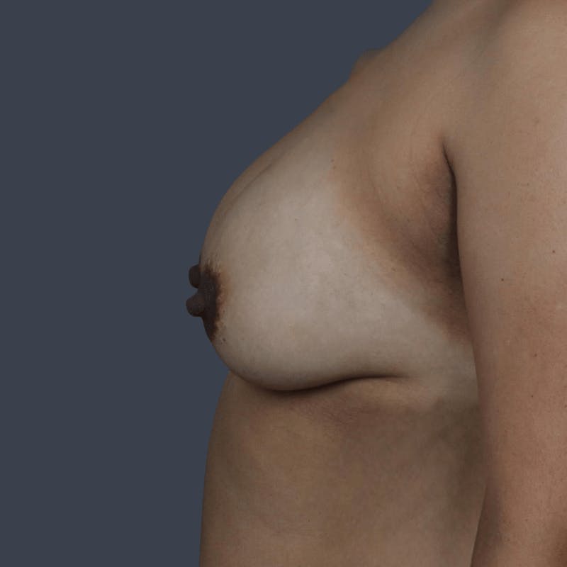 Implant Breast Reconstruction Before & After Gallery - Patient 271058 - Image 5