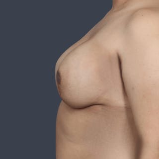 Implant Breast Reconstruction Before & After Gallery - Patient 271058 - Image 6