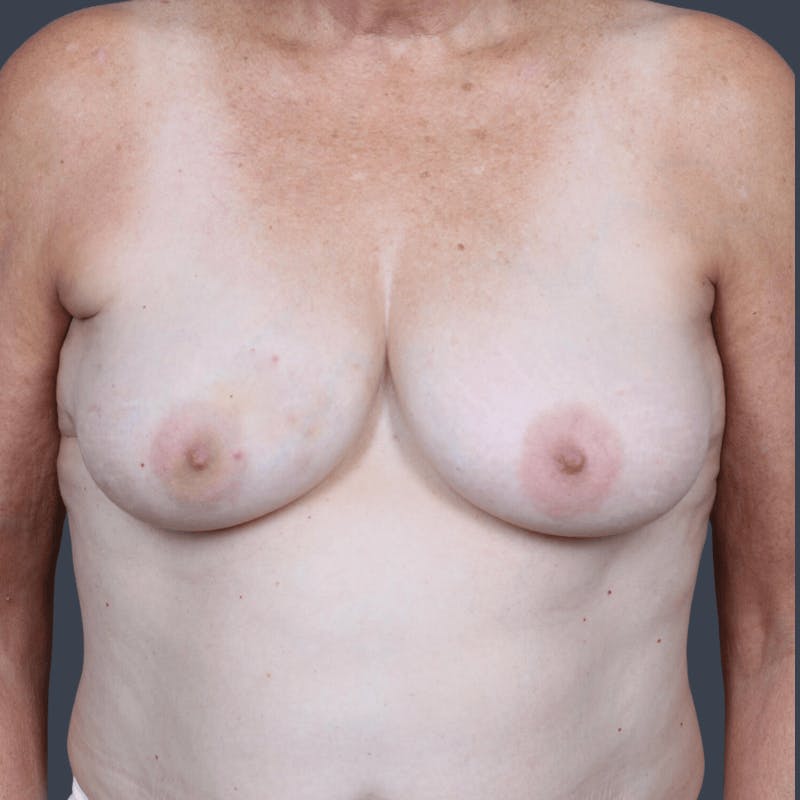 Implant Breast Reconstruction Before & After Gallery - Patient 132687 - Image 1