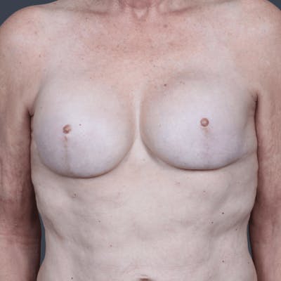 Implant Breast Reconstruction Before & After Gallery - Patient 132687 - Image 2