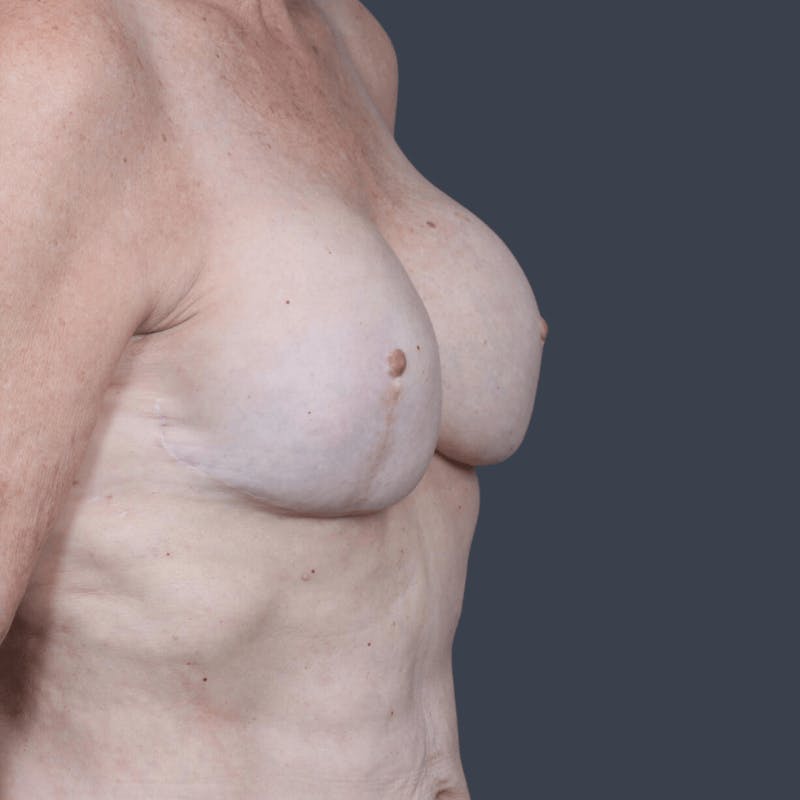 Implant Breast Reconstruction Before & After Gallery - Patient 132687 - Image 4