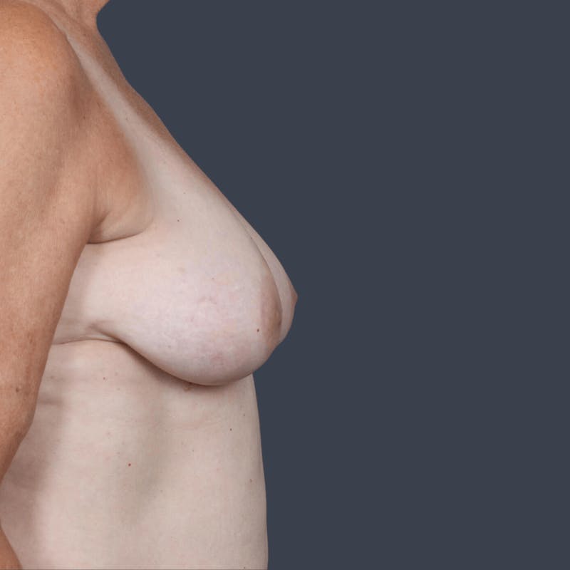 Implant Breast Reconstruction Before & After Gallery - Patient 132687 - Image 5