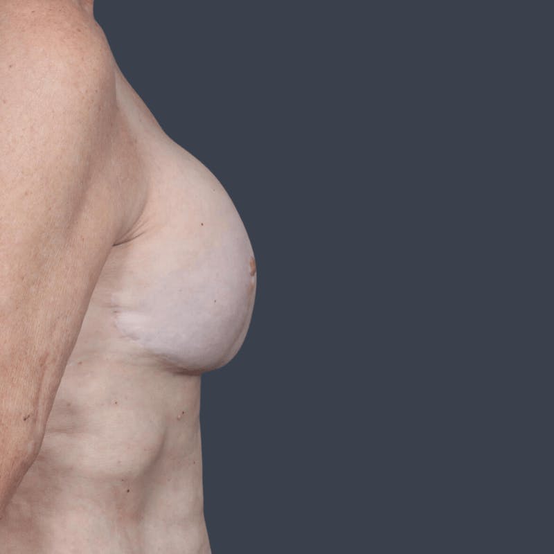 Implant Breast Reconstruction Before & After Gallery - Patient 132687 - Image 6