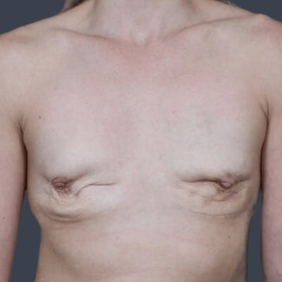 Implant Breast Reconstruction Before & After Gallery - Patient 355267 - Image 1