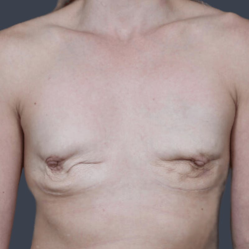 Implant Breast Reconstruction Before & After Gallery - Patient 355267 - Image 1
