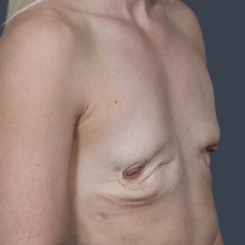 Implant Breast Reconstruction Before & After Gallery - Patient 355267 - Image 3