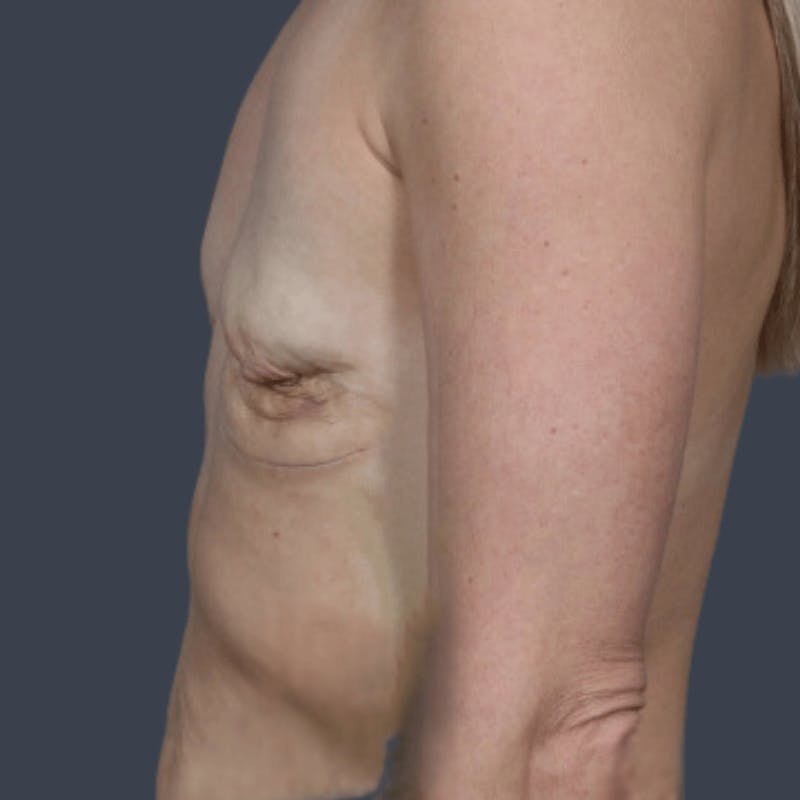 Implant Breast Reconstruction Before & After Gallery - Patient 355267 - Image 5