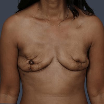 Implant Breast Reconstruction Before & After Gallery - Patient 277097 - Image 1