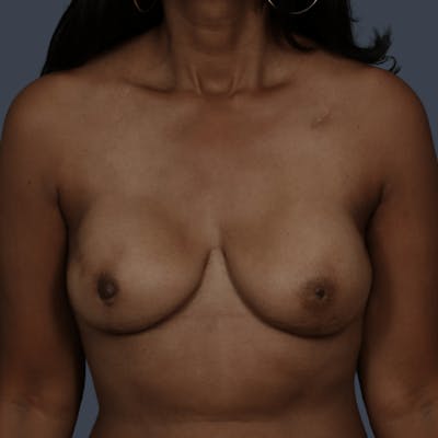 Implant Breast Reconstruction Before & After Gallery - Patient 277097 - Image 2