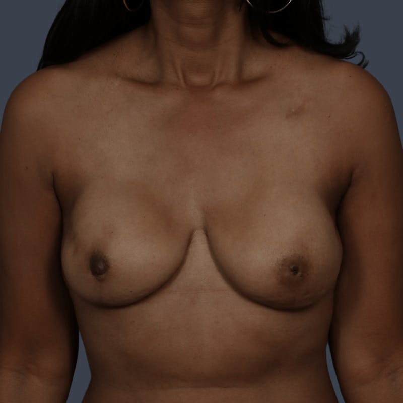 Implant Breast Reconstruction Before & After Gallery - Patient 277097 - Image 2