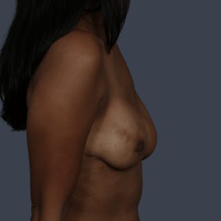 Implant Breast Reconstruction Before & After Gallery - Patient 277097 - Image 4