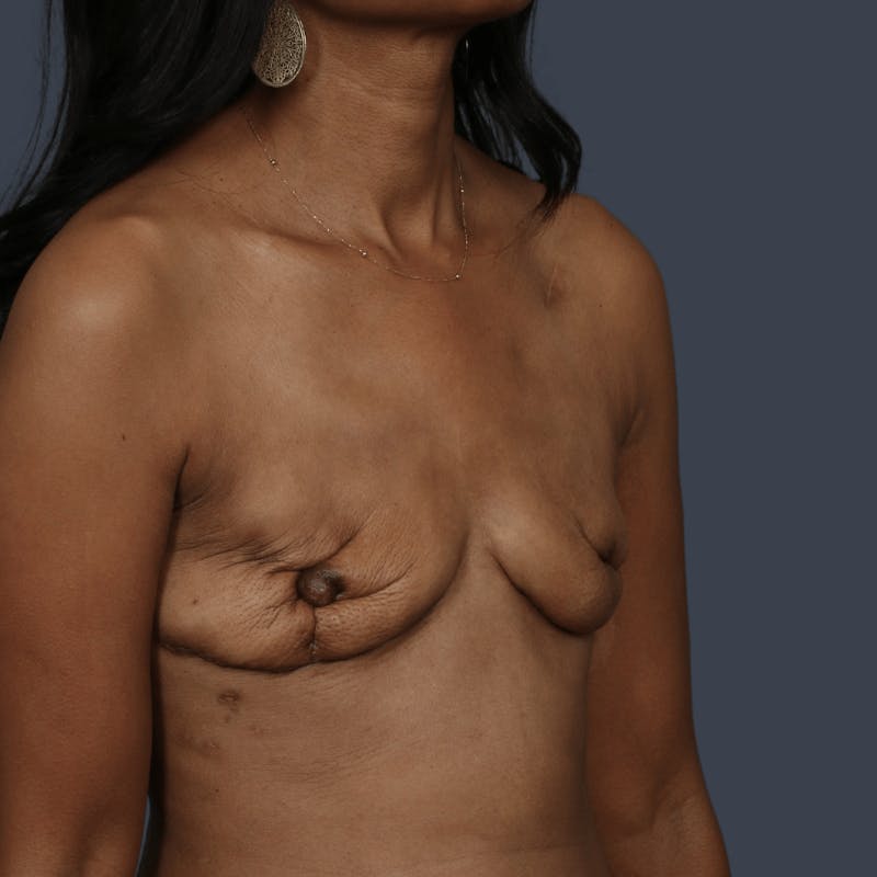 Implant Breast Reconstruction Before & After Gallery - Patient 277097 - Image 5