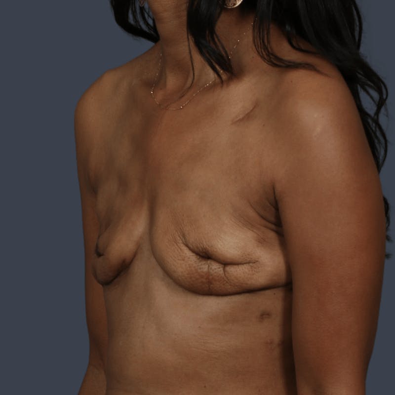 Implant Breast Reconstruction Before & After Gallery - Patient 277097 - Image 7