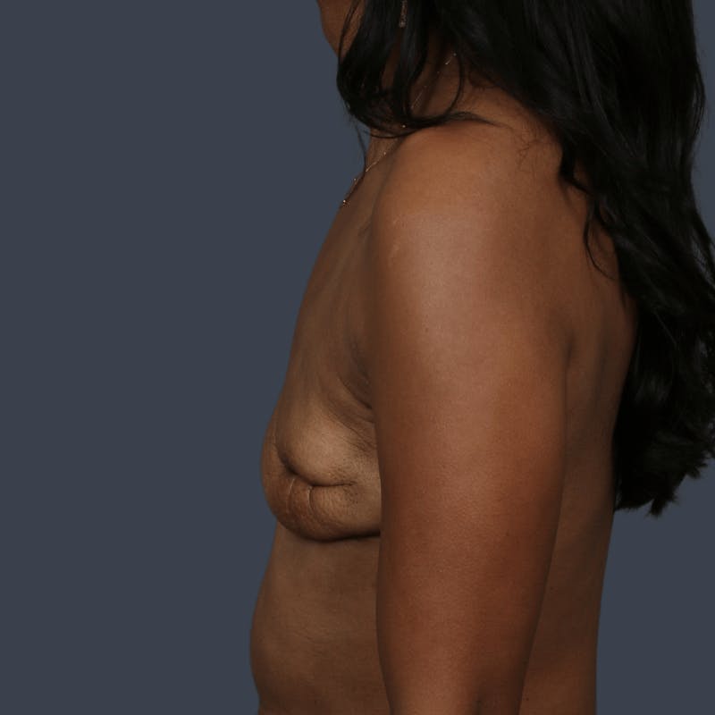 Implant Breast Reconstruction Before & After Gallery - Patient 277097 - Image 9
