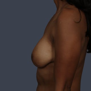 Implant Breast Reconstruction Before & After Gallery - Patient 277097 - Image 10
