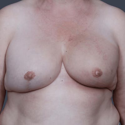 Implant Breast Reconstruction Before & After Gallery - Patient 134379 - Image 2