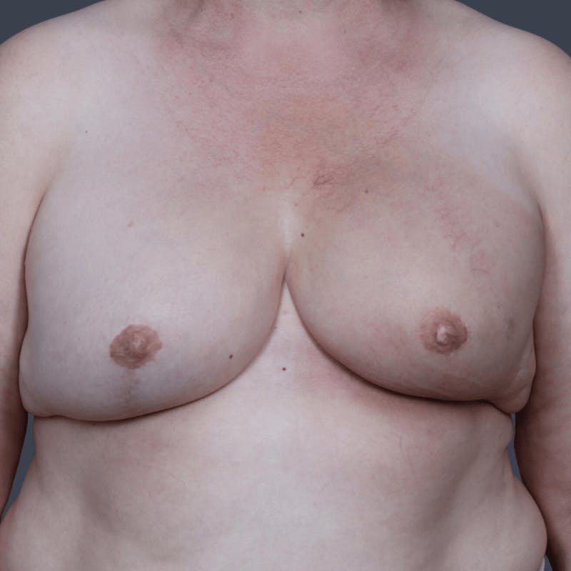 Implant Breast Reconstruction Before & After Gallery - Patient 134379 - Image 2