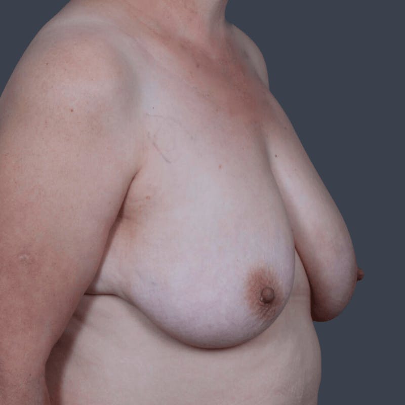 Implant Breast Reconstruction Before & After Gallery - Patient 134379 - Image 3