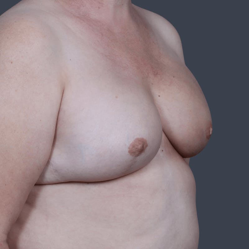 Implant Breast Reconstruction Before & After Gallery - Patient 134379 - Image 4