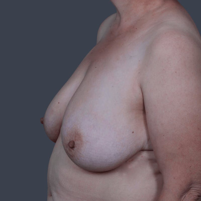 Implant Breast Reconstruction Before & After Gallery - Patient 134379 - Image 5
