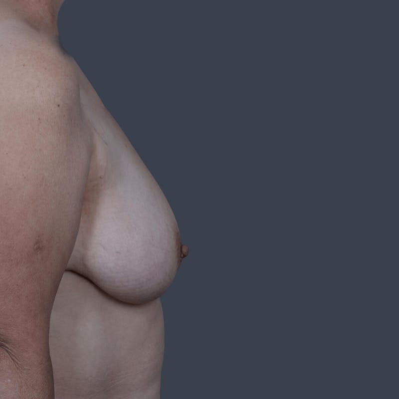 Implant Breast Reconstruction Before & After Gallery - Patient 134379 - Image 7
